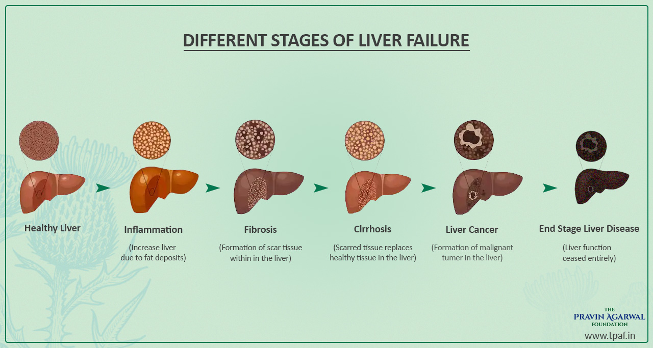 progress of liver disease liver